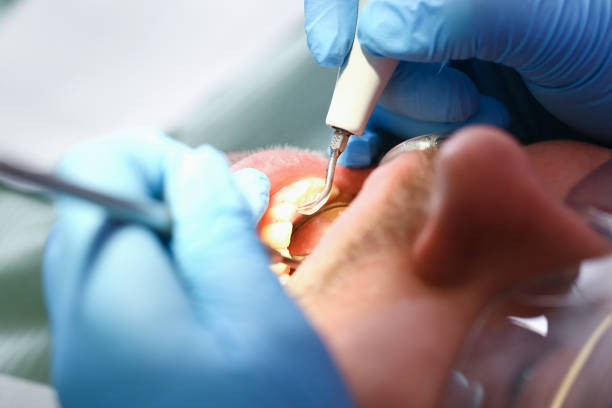 Best Emergency Dental Care for Broken or Chipped Teeth in Simi Valley, CA